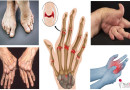 Rheumatoid Arthritis is a multi-organ scourge
